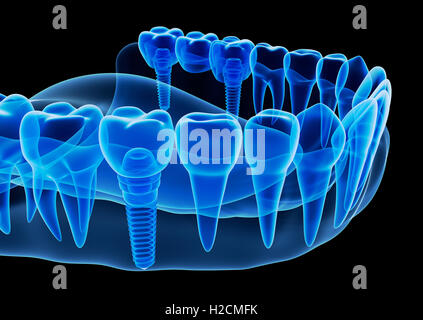 X-ray view of denture with implant Stock Photo