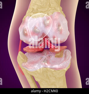 Osteoporosis of the knee joint,  Medically accurate 3D illustration Stock Photo