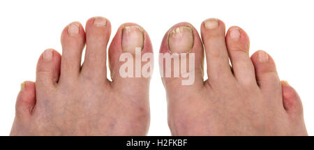Ugly nails on toes at the elderly no name man.The man saws nails a file that they didn't crash into meat. Isolated on white Stock Photo