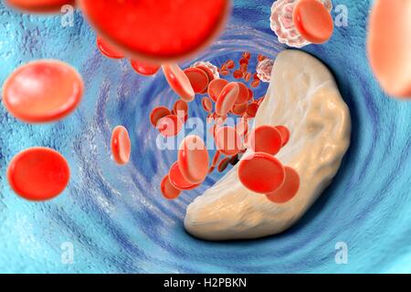 Atheromatous plaque inside blood vessel, computer illustration. Cholesterol atheroma causing a narrowing of an artery (atherosclerosis). Stock Photo