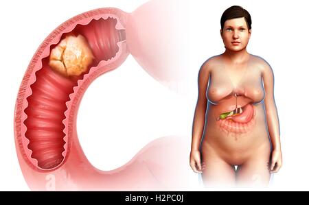 Illustration of a woman with small intestine cancer. Stock Photo