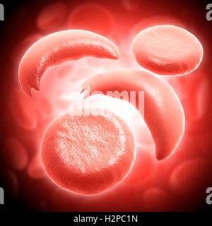 Illustration of red blood cells in sickle cell anaemia. Stock Photo