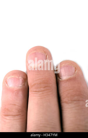 Close up of bitten fingernails isolated on a white background. Stock Photo