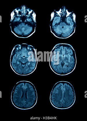 MRI Image Brain On Black Background Stock Photo - Alamy