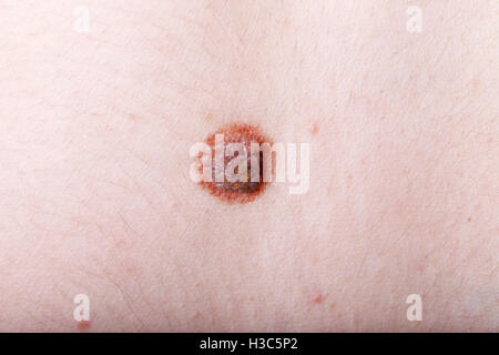a large mole on a woman's body, close-up, medicine, health Stock Photo