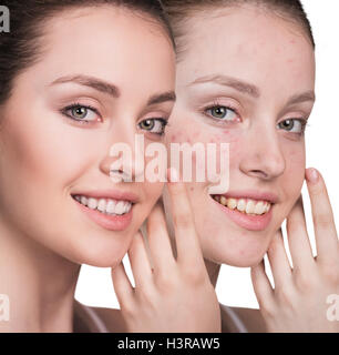 Woman with problem skin on her face Stock Photo