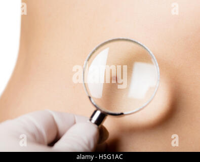 mole on body a person under the magnifying glass Stock Photo