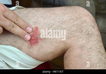 Applying anti insect bite gel on skin of a leg in the place of irritation because of an unknown insect bite Stock Photo