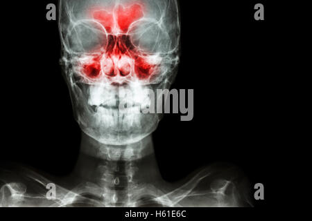 Sinusitis. film x-ray skull AP ( anterior - posterior ) show infection and inflammation at frontal sinus , ethmoid sinus , maxil Stock Photo