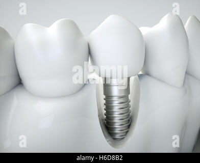Dental implant - 3d rendering Stock Photo