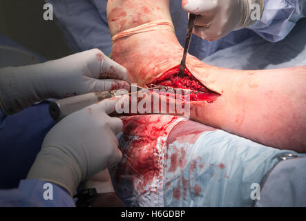 Open reduction and internal fixation of ankle-Ankle operation Stock Photo