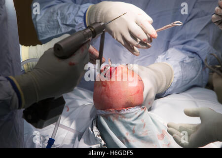 External fixation of radial head of elbow.Surgeons perform an elbow operation Stock Photo