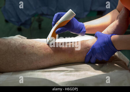 Preparation of patient for Open reduction and internal fixation of ankle-Ankle operation.The patient's leg is shaved Stock Photo