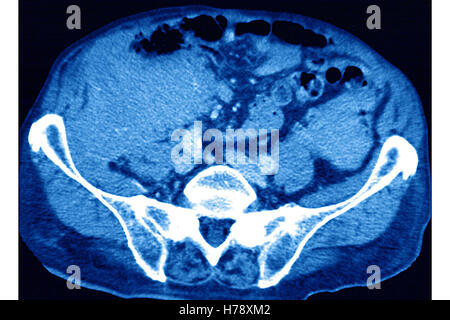 AMYLOIDOSIS CT-SCAN Stock Photo