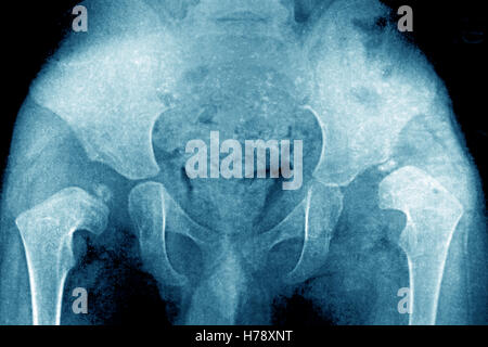 X ray congenital dislocation of hips Stock Photo: 2835175 - Alamy