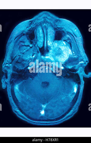 NEURINOMA MRI Stock Photo