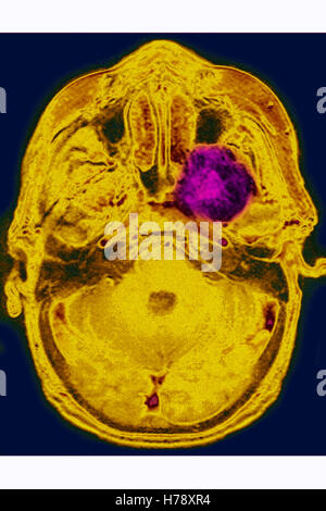 NEURINOMA MRI Stock Photo