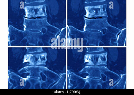 PAGET'S DISEASE, MRI Stock Photo