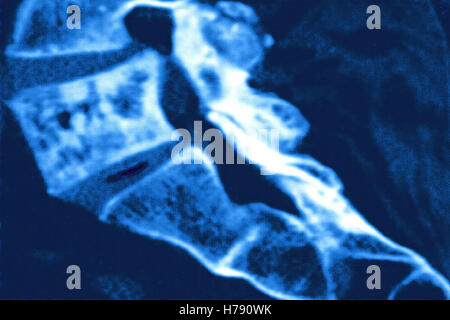 PAGET'S DISEASE, MRI Stock Photo