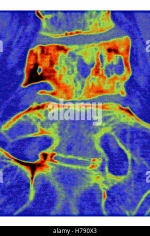 PAGET'S DISEASE, MRI Stock Photo