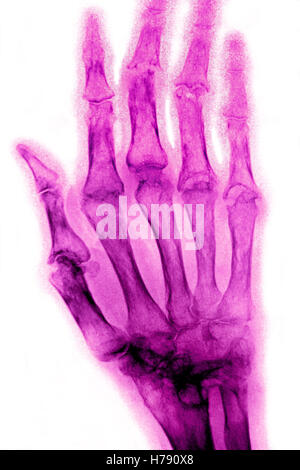 RHEUMATOID ARTHRITIS, X-RAY Stock Photo