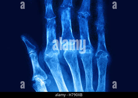 RHEUMATOID ARTHRITIS, X-RAY Stock Photo