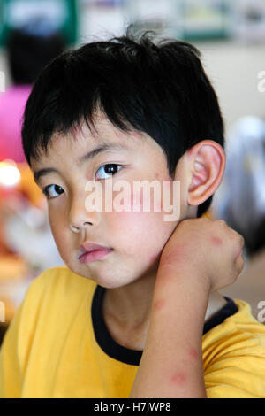 Boy With Multiple And Insect Bites On Body On White Background Stock 