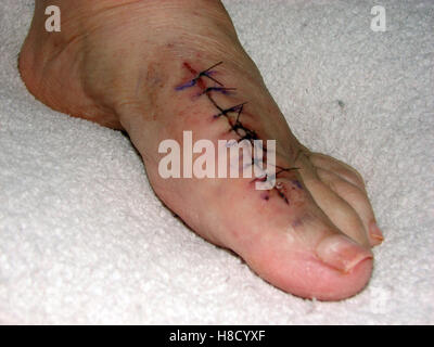 Incision and stitches on a foot after removing the medical appliances from a failed Bunion Surgery Stock Photo