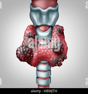 Thyroid gland cancer concept as a human organ with a malignant tumor growth as a symbol for endocrinology system disease with 3D illustration elements. Stock Photo