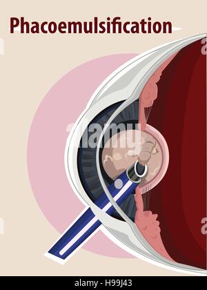 Vector illustration of  Cataract surgery Stock Vector