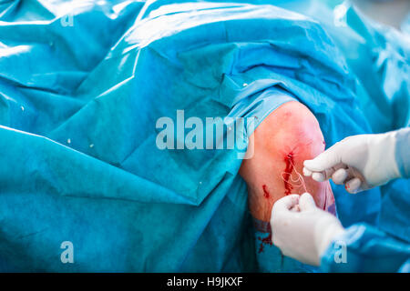 Knee surgery, Orthopedic Operation  - two surgeons performing a knee surgery on a patient (shallow DOF; color toned image) Stock Photo