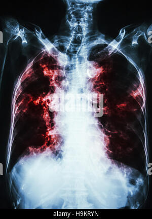 Pneumonia. X-ray of the chest of a patient with bacterial pneumonia ...