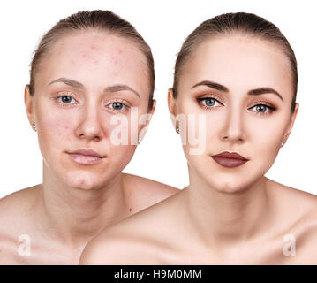 Woman with problem skin on her face Stock Photo