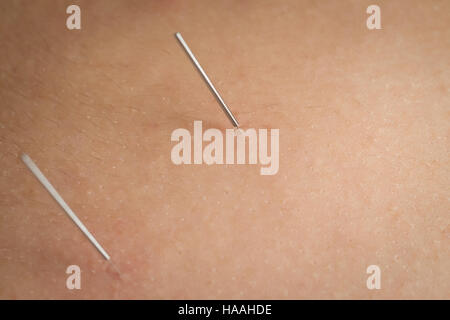 Close-up of a patient getting dry needling Stock Photo