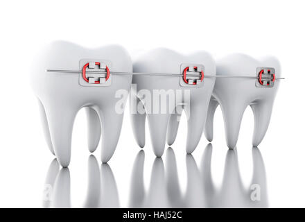 3D Illustration. Tooth with braces. Dental care concept. Isolated white background. Stock Photo