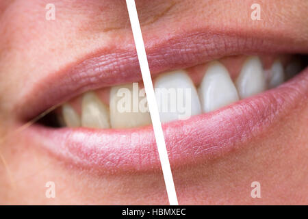 woman teeth before and after whitening Stock Photo