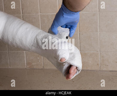 Orthopedic technician putting on a fiberglass / plaster cast on a young man's broken and fractured arm after an injury.  Close up image shows the cast Stock Photo