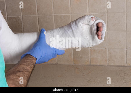Orthopedic technician putting on a fiberglass / plaster cast on a young man's broken and fractured arm after an injury.  Close up image shows the cast Stock Photo