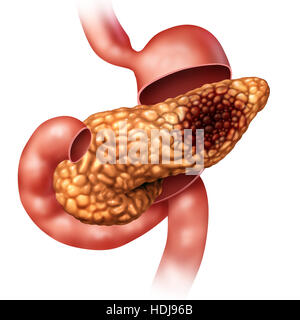 Pancreatic cancer concept and Pancreas malignant tumor symbol as a digestive gland body part with stomach cross section with a malignant tumor growth Stock Photo
