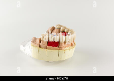 denture made of ceramics located on plaster model Stock Photo