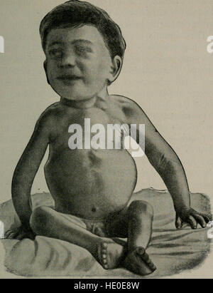 Diseases of children, for nurses, including infant feeding, therapeutic measures employed in childhood, treatment for emergencies, prophylaxis, hygiene, and nursing (1921) Stock Photo