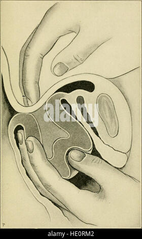 The Principles and practice of gynecology - for students and practitioners (1904) Stock Photo
