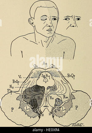 Diseases of the nervous system - a text-book of neurology and psychiatry (1915)
