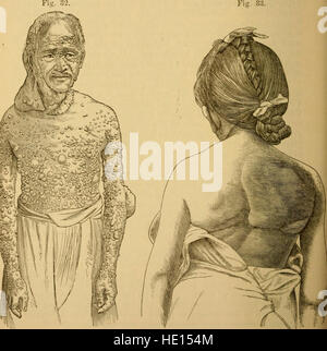 A practical treatise on diseases of the skin, for the use of students and practitioners (1883) Stock Photo