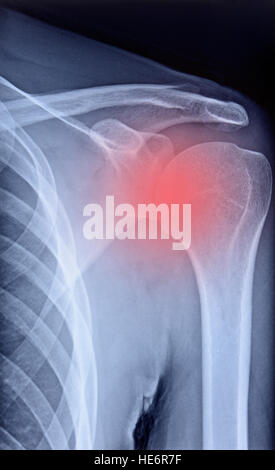 radiography of the shoulder joint highlighted in red Stock Photo