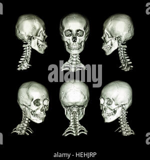 CT scan and 3D image . Normal human skull and cervical spine . all direction Stock Photo