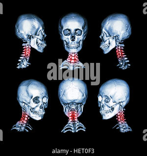 CT scan and 3D image of skull and neck . Use this image for cervical spondylosis , spondylolisthesis , spondylitis , spine trauma condition . Stock Photo