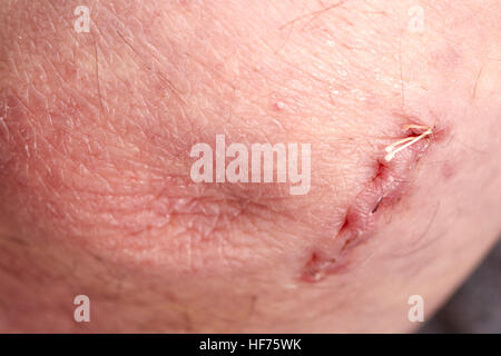 cubital dissolvable wound correct surgical elbow stitches tunnel syndrome alamy