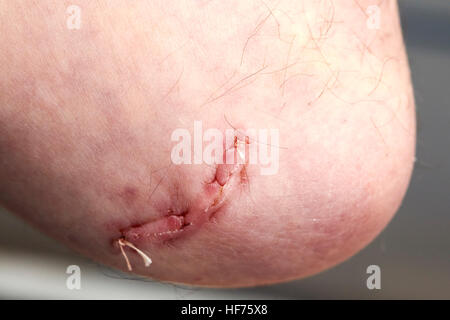 dissolvable stitches in an elbow surgical wound to correct cubital tunnel syndrome Stock Photo
