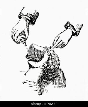 History of medicine. Chloroform anesthesia. Engraving, 19th century. Colored Stock Photo - Alamy